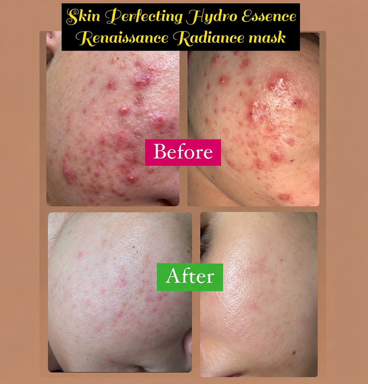 Anti Acne Deal (essence+h2O+mask)